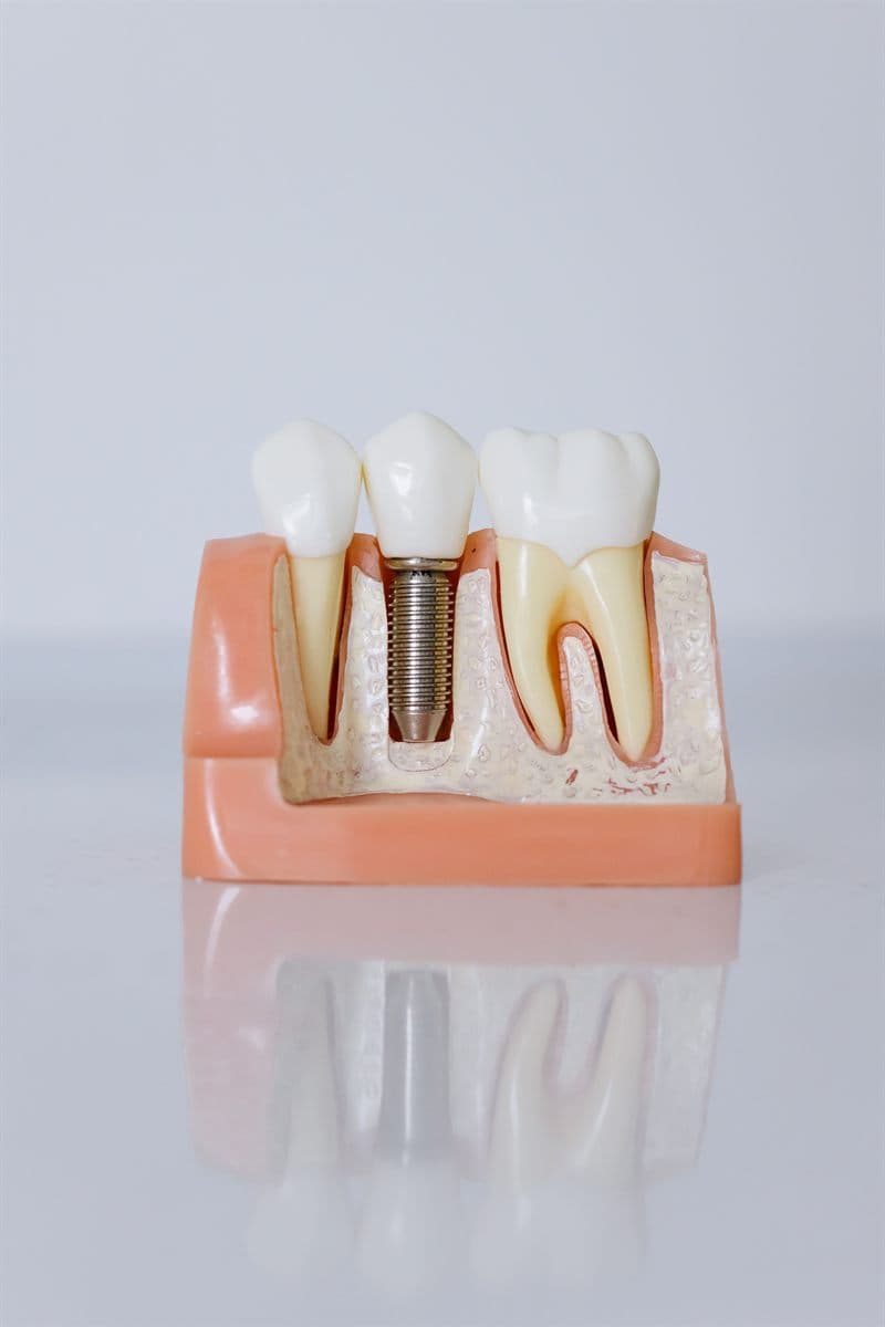 Implantes dentários - atendimento da Dra. Raíssa Santanna